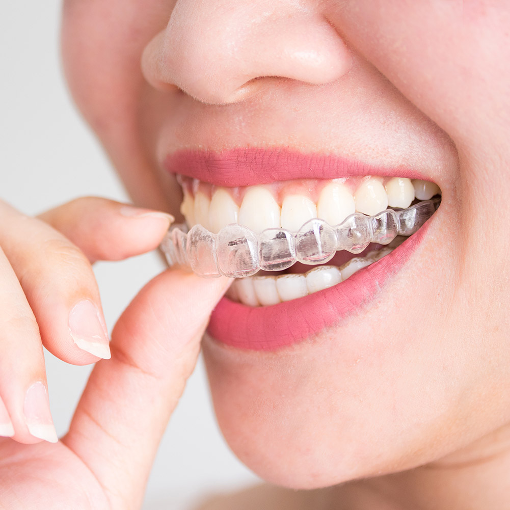 Teeth Whitening Mouth Guard - 2/4pcs Mouth Guard Teeth Protector Guard
