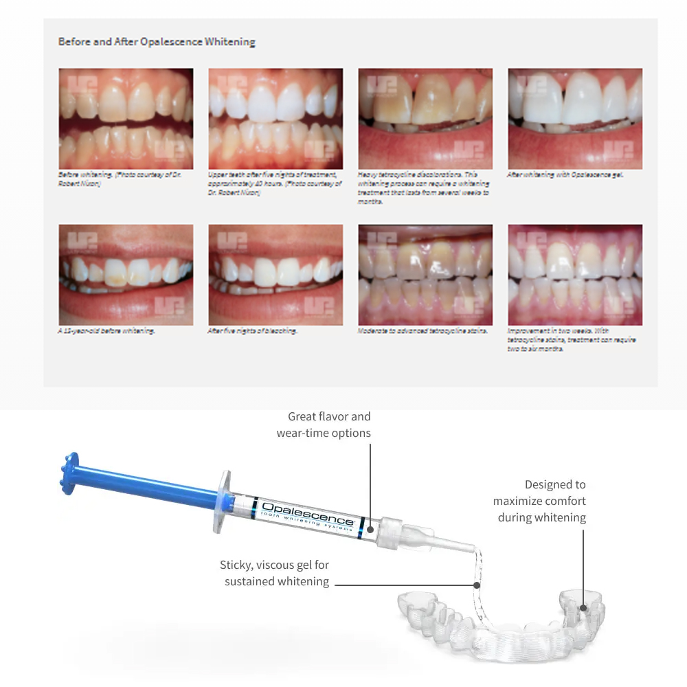 Opalescence Whitening 20% PF 2 - Teeth Whitening Singapore 리뷰 및 가격