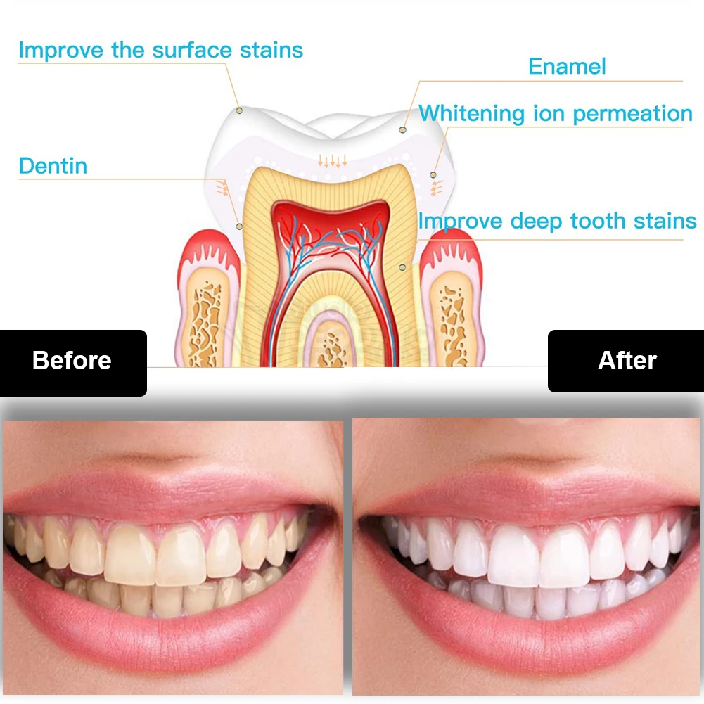 Dental Teeth Whitening Kit Min - Teeth Whitening Singapore 리뷰 및 가격