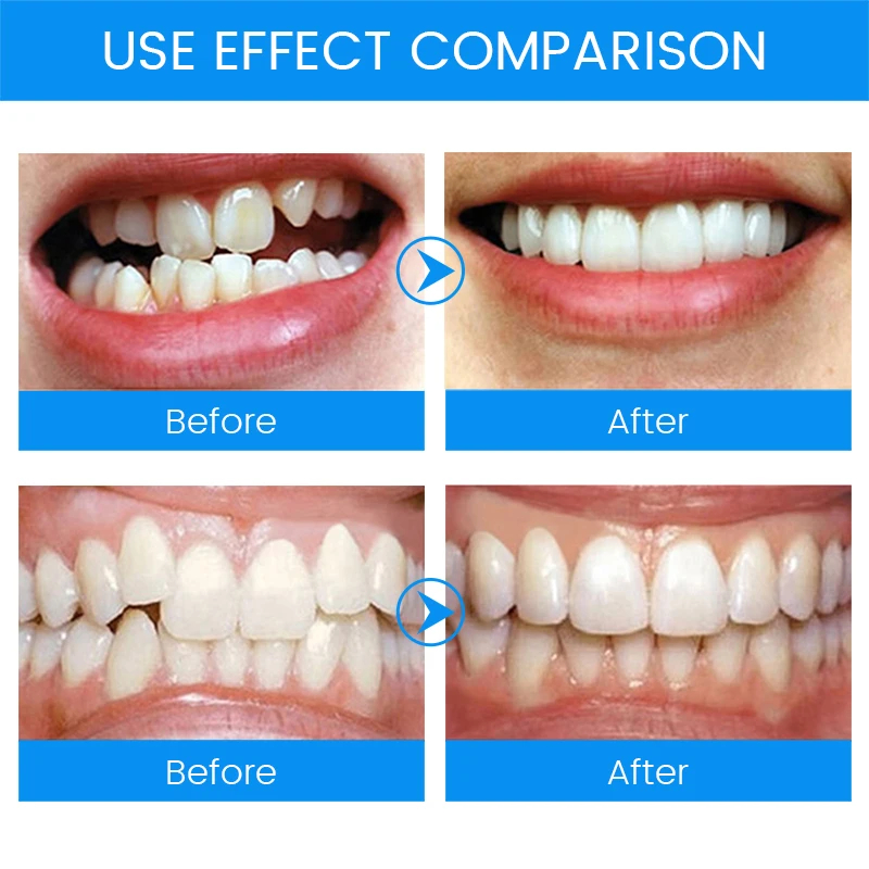 3 Stages Dental Orthodontic Br - Teeth Whitening Mouth Guard 리뷰 및 가격